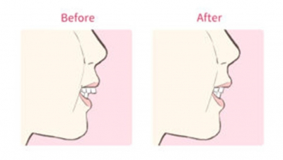 口を開いている横顔の比較図