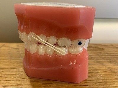 顎間ゴムがつけてある顎模型